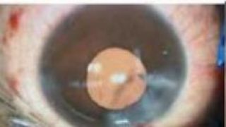 艾芬,自查,白內障,視網膜,愛爾,脫落 愛爾眼科自查報告：艾芬醫生視網膜脫落與白內障手術無直接關聯